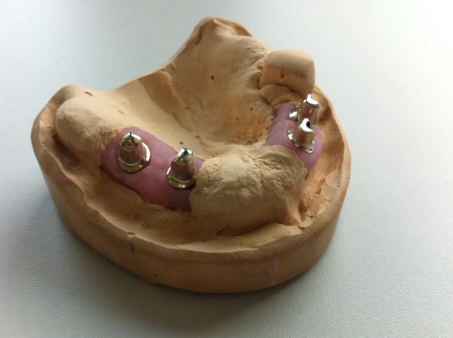 Recondent.ro - Tehnica Dentara Timisoara - Restaurari Protetice pe Implanturi