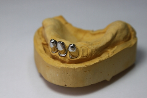 Recondent.ro - Tehnica Dentara Timisoara - Restaurari Protetice pe Implanturi